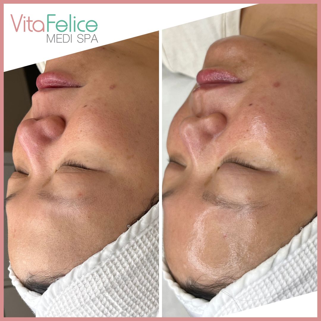 Protein Skin Tightening Facial - New Westminster