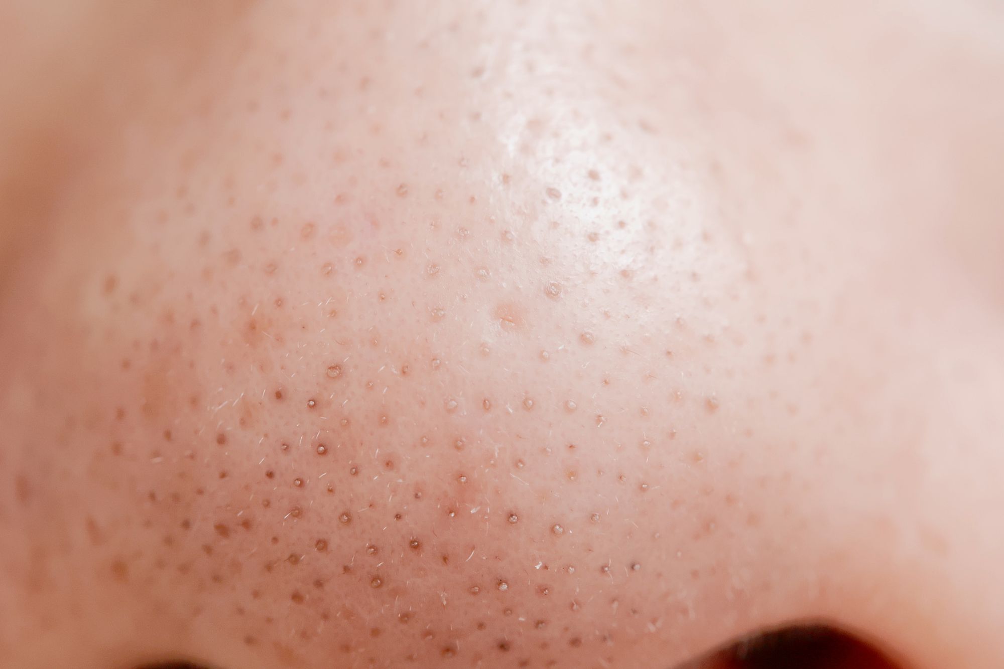 Sebaceous Filaments vs Blackheads