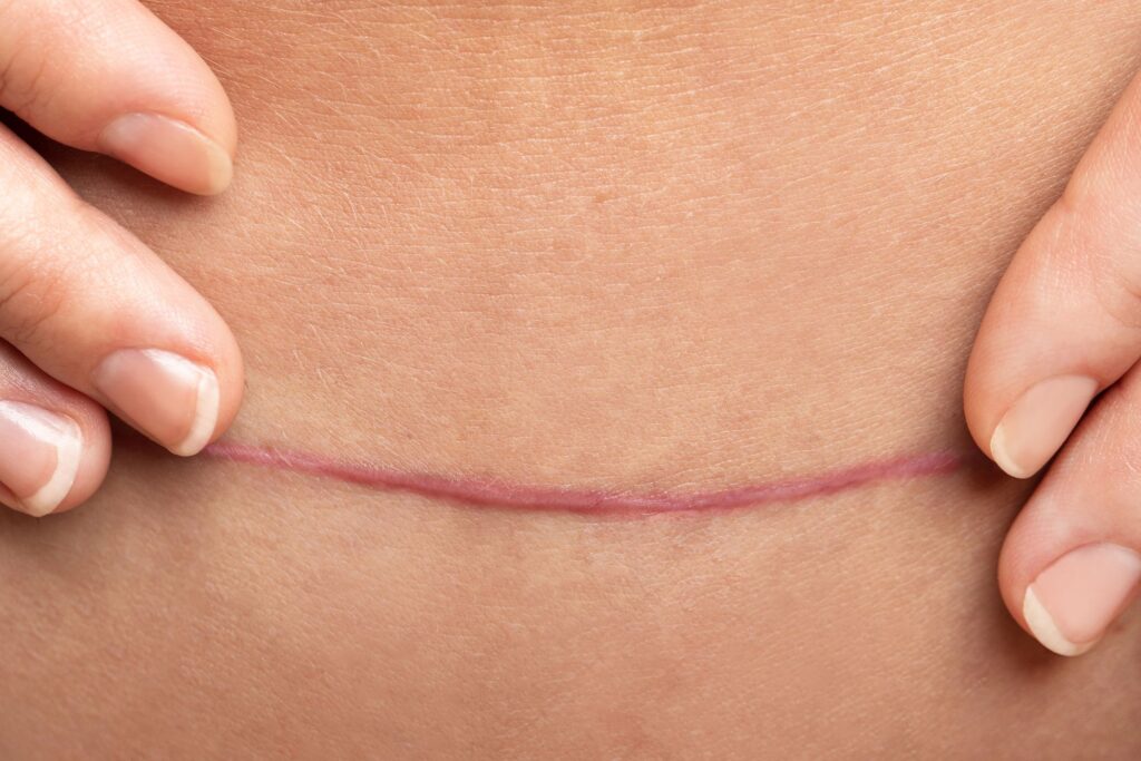 Surgical scar on skin with hands gently touching, illustrating the focus on scar treatment options at Vita Felice Medi Spa in New Westminster.