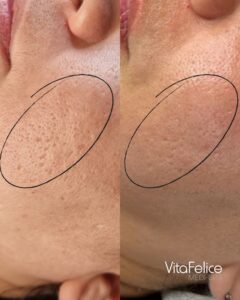 Acne Scar Reduction New Westminster