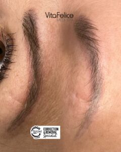 Botched Ink Tattoo Removal Burnaby