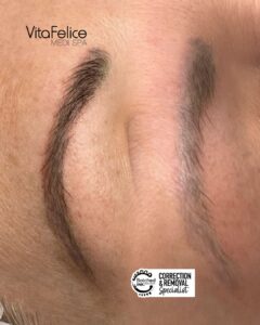 Botched Ink Tattoo Removal Surrey