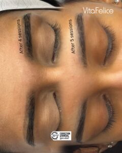 Saline Tattoo Removal Surrey before and after