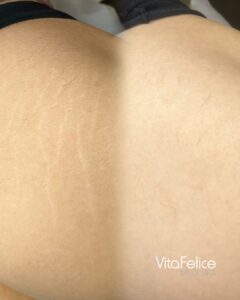 Stretch mark treatment before after New westminster