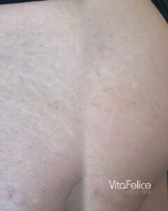 Stretch mark treatment before after Surrey