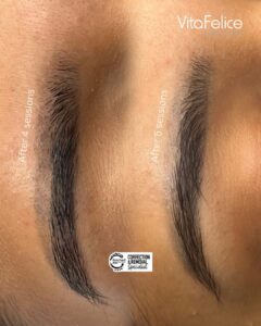 Tattoo Removal Progress New westminster